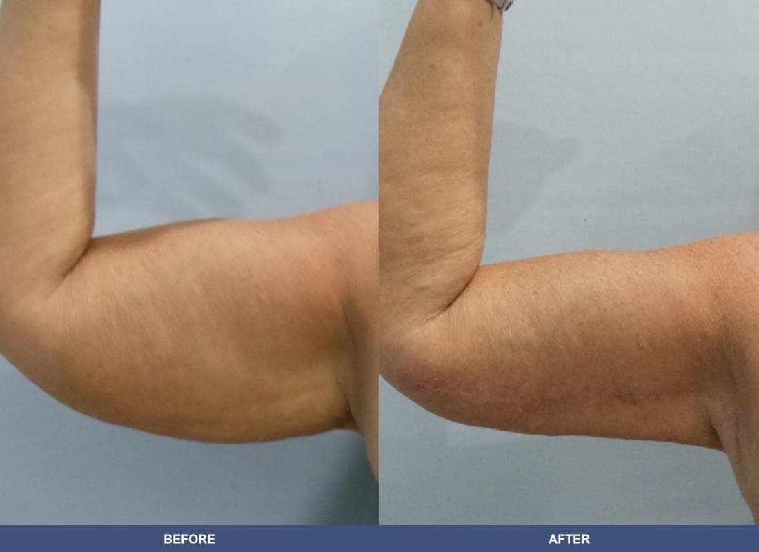 Arm Lift before and after