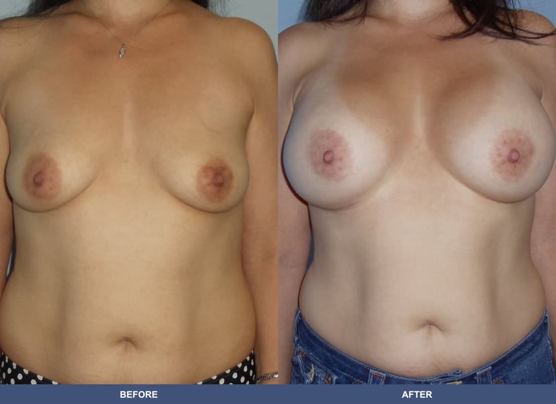 Painless Breast Implants before and after