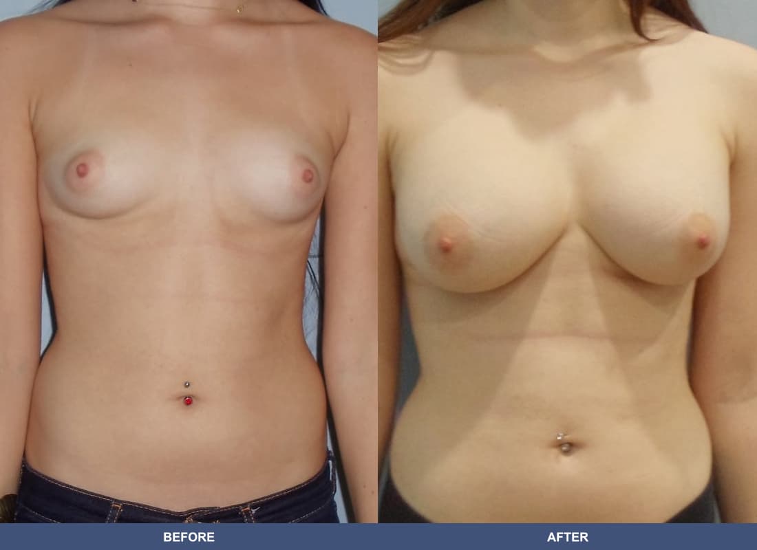 Painless Breast Implants before and after