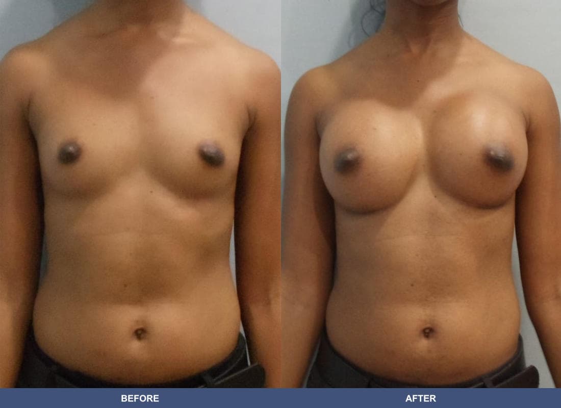 Painless Breast Implants before and after