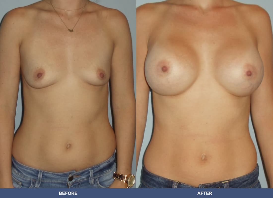Painless Breast Implants before and after
