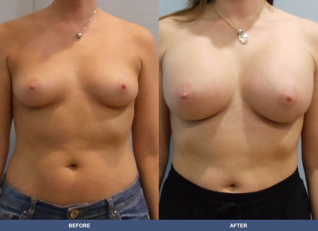 Painless Breast Implants before and after