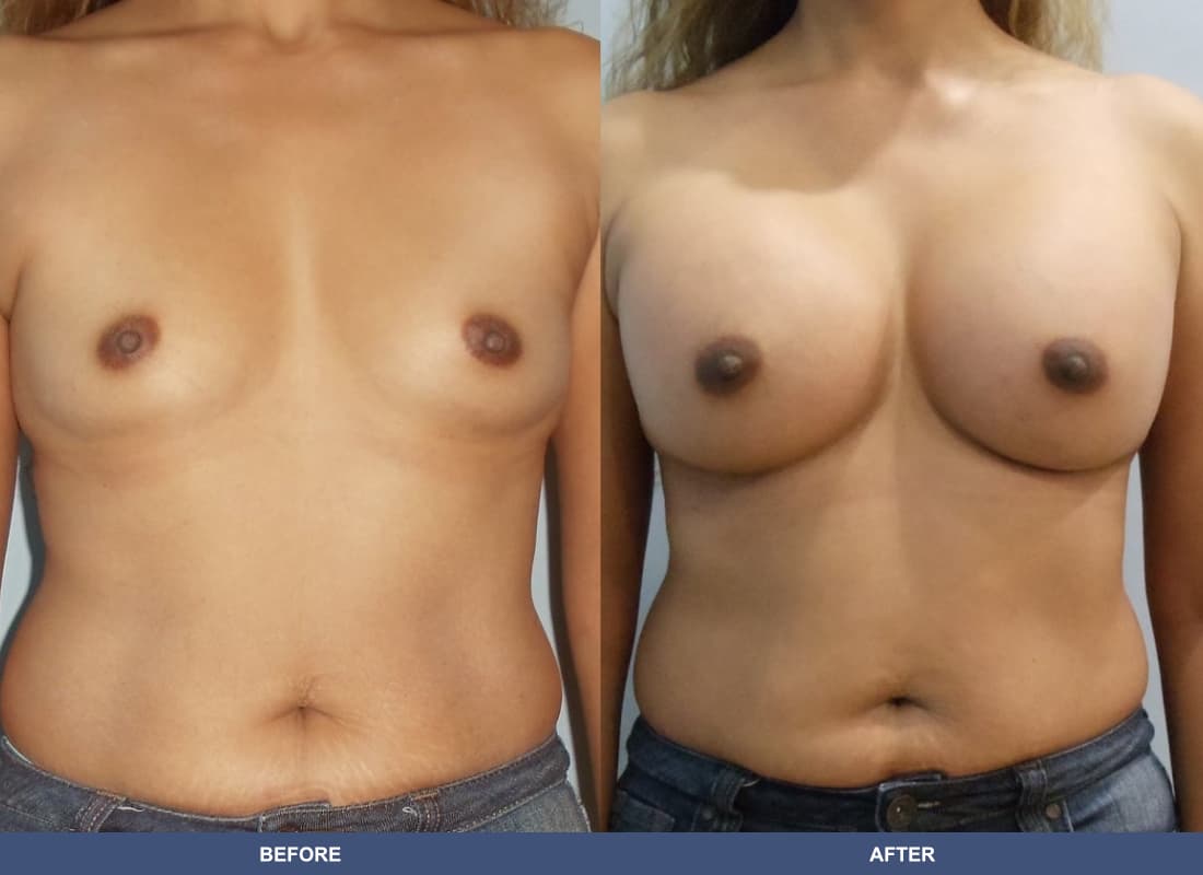 Painless Breast Implants before and after