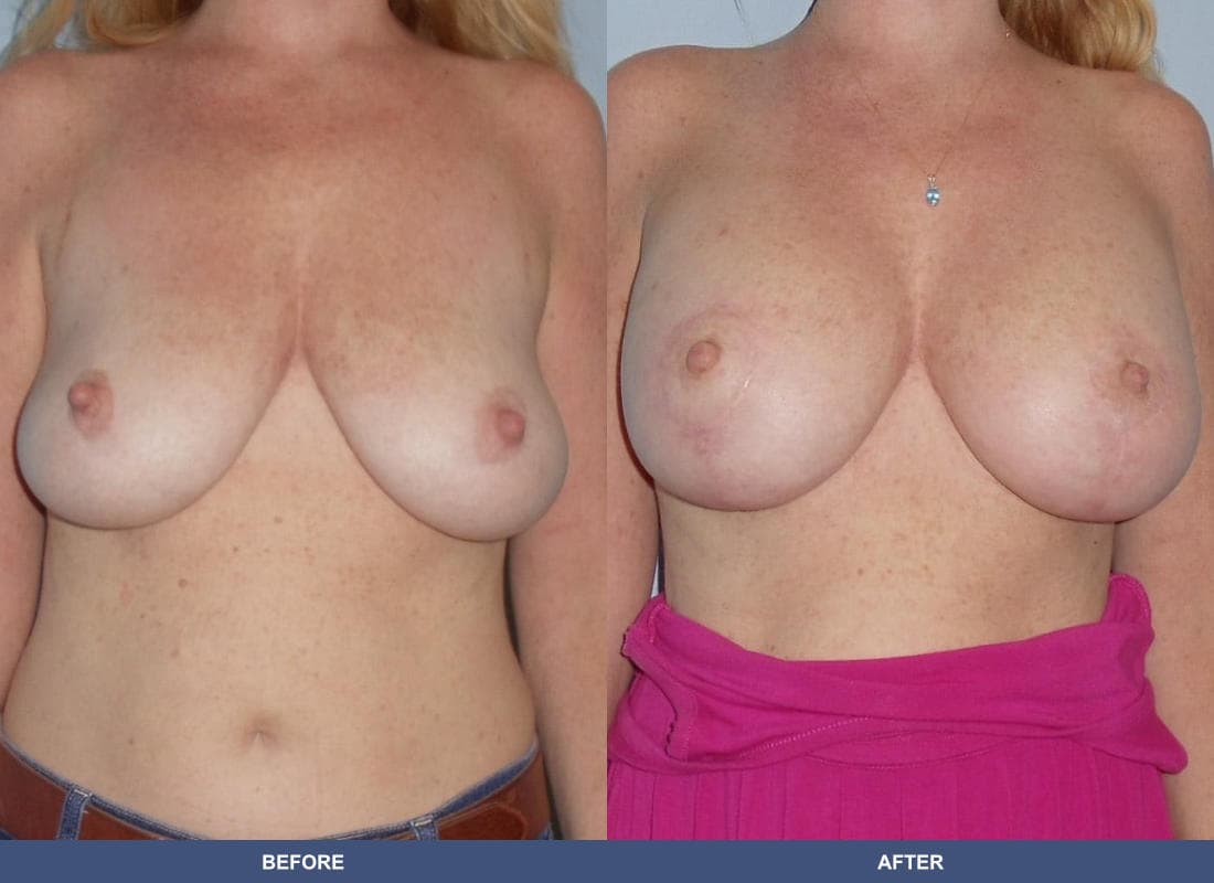 Breast Augmentation with a Lift before and after