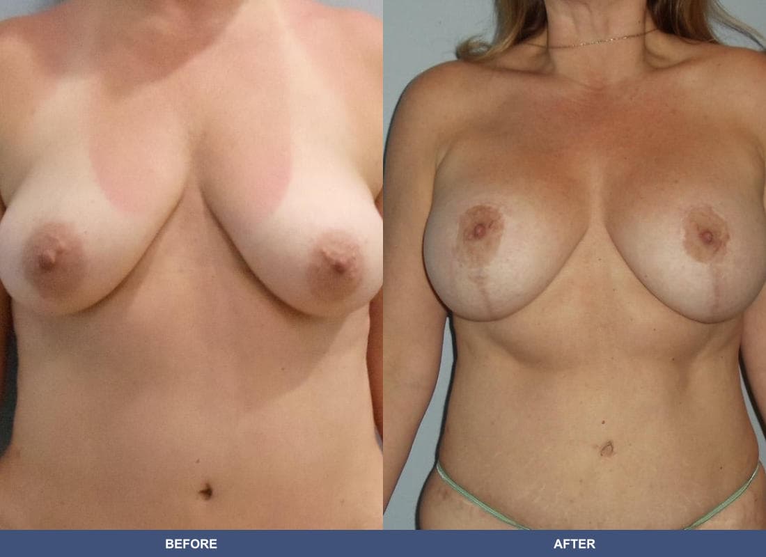 Breast Augmentation with a Lift before and after