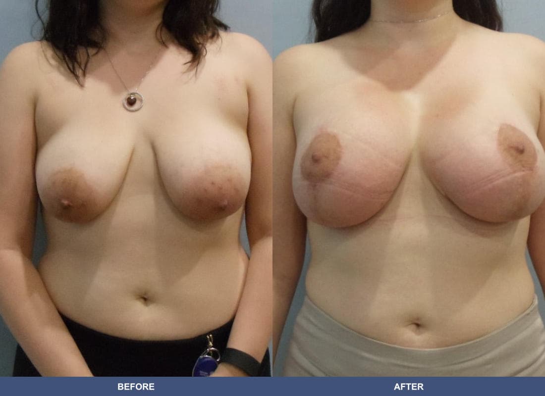 Breast Augmentation with a Lift before and after