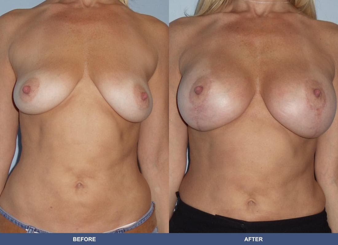 Breast Augmentation with a Lift before and after