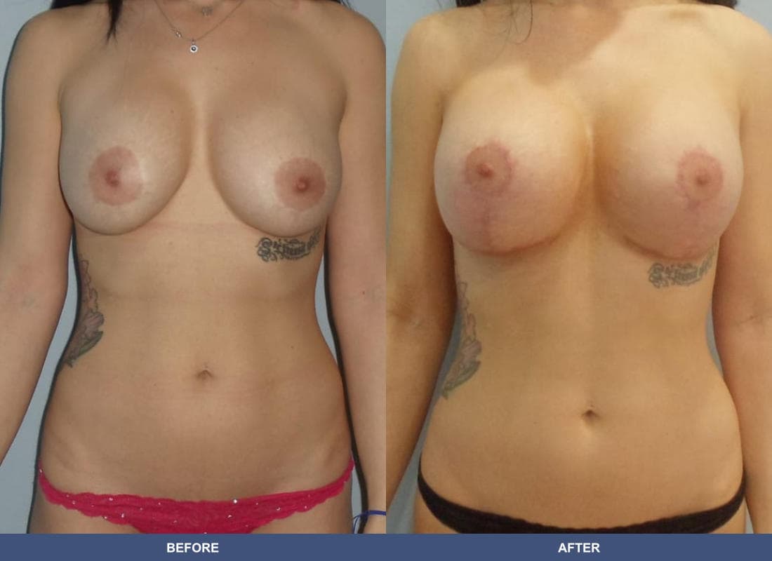 Breast Augmentation with a Lift before and after