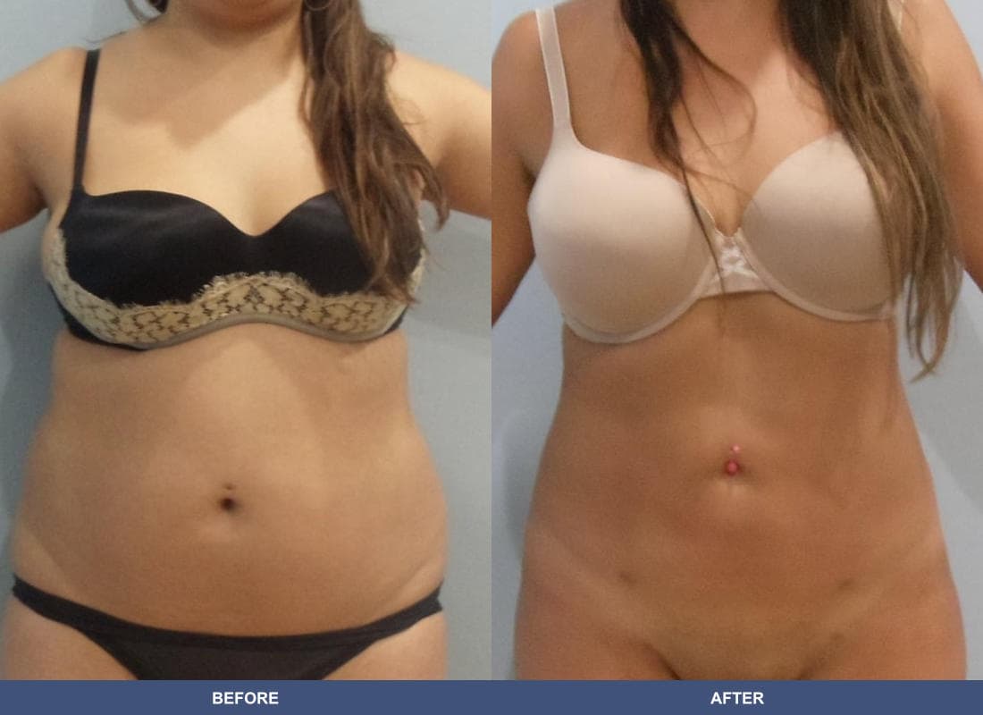 Brazilian Butt Lift before and after