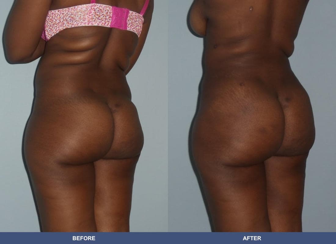 Brazilian Butt Lift before and after