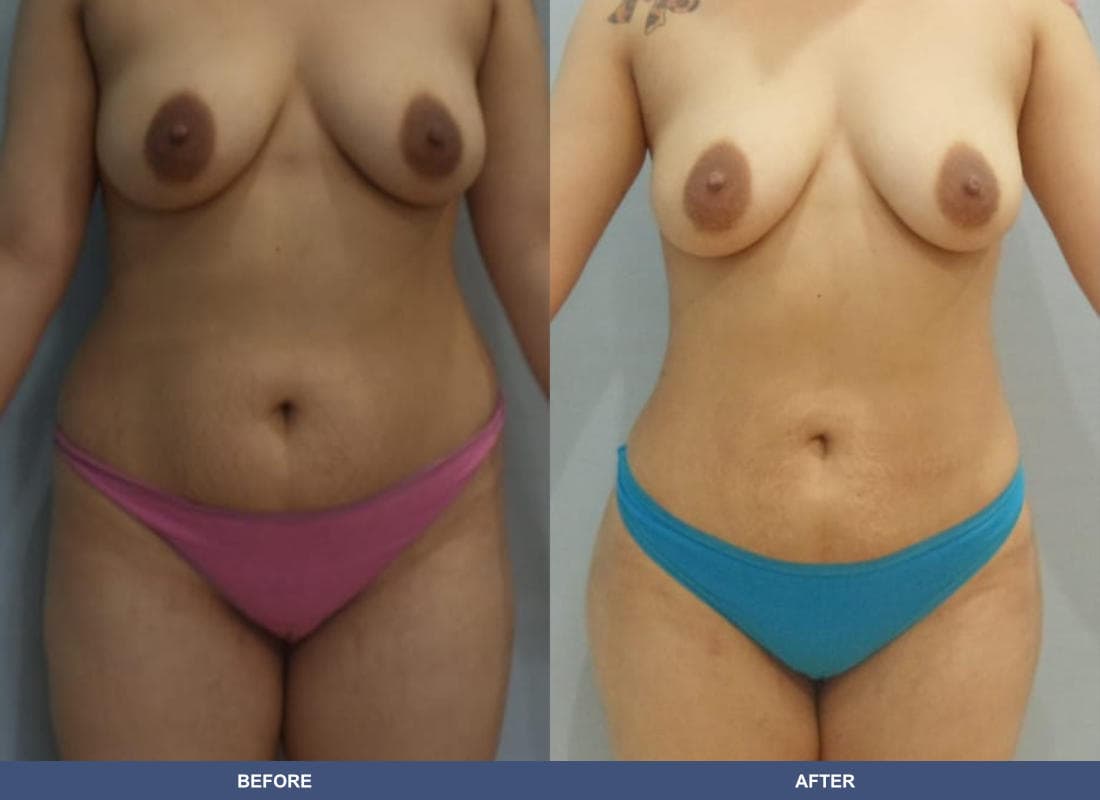 Brazilian Butt Lift before and after