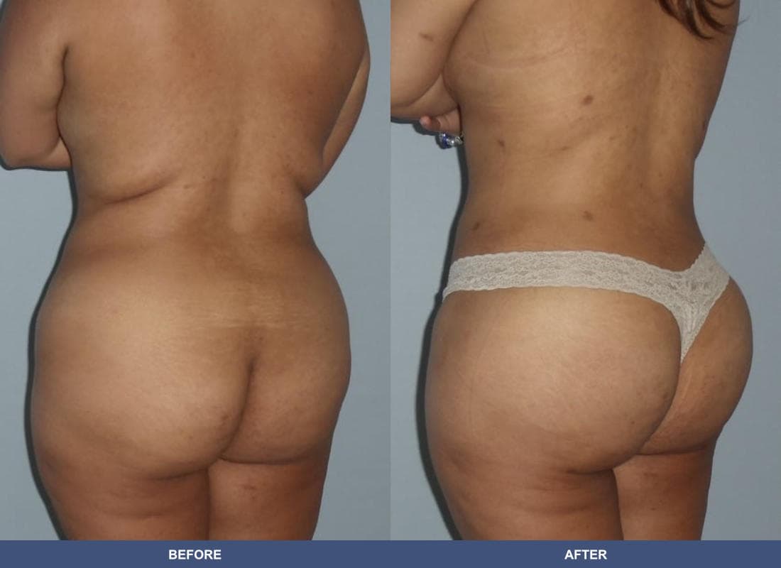Brazilian Butt Lift before and after