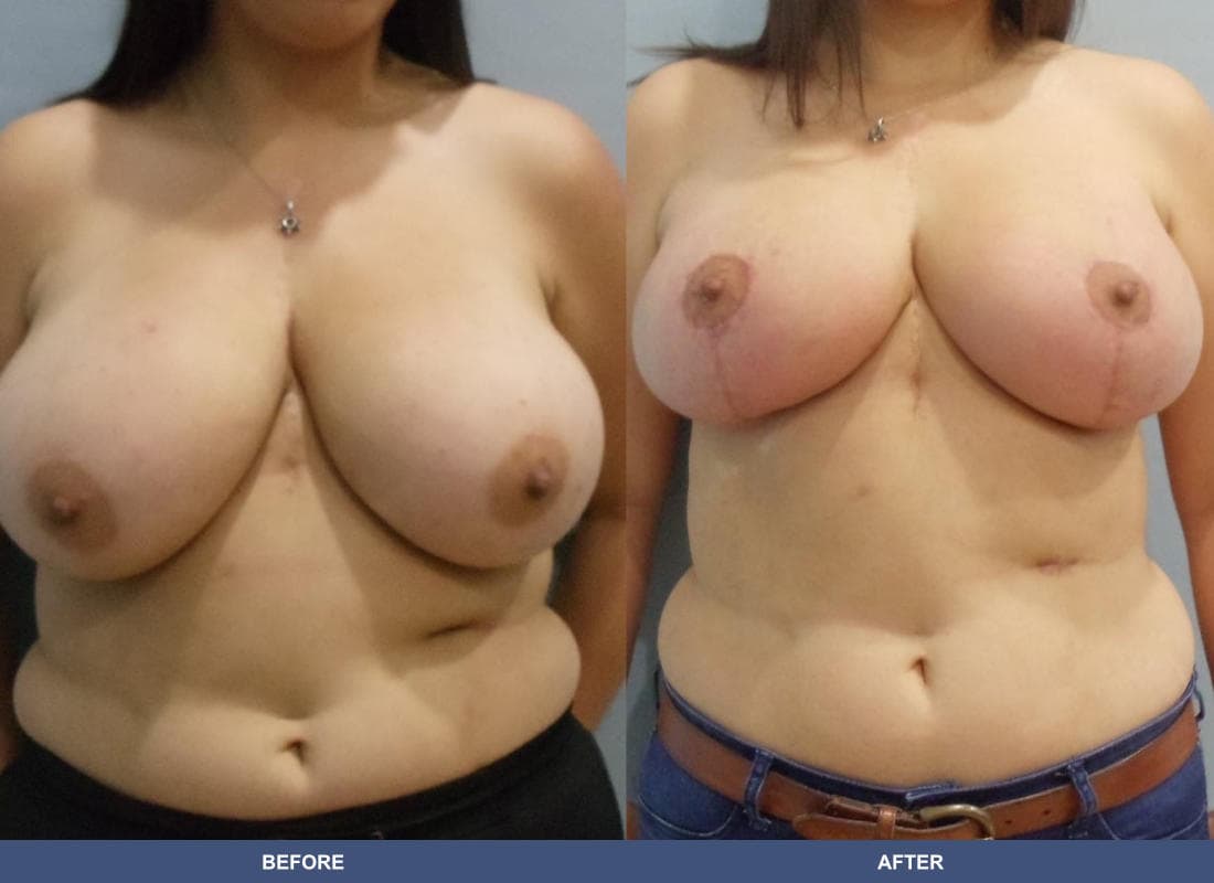 Breast Lift / Reduction before and after
