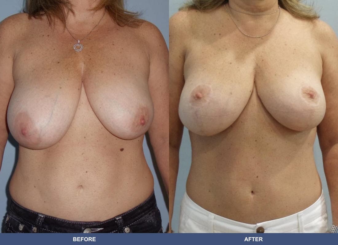 Breast Lift / Reduction before and after
