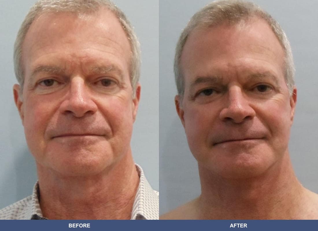 Face and Neck Lift before and after