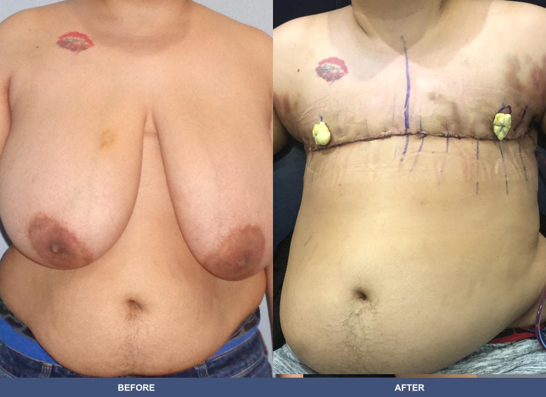 Gender Confirmation (FTM) before and after