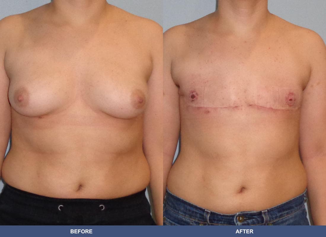 Gender Confirmation (FTM) before and after