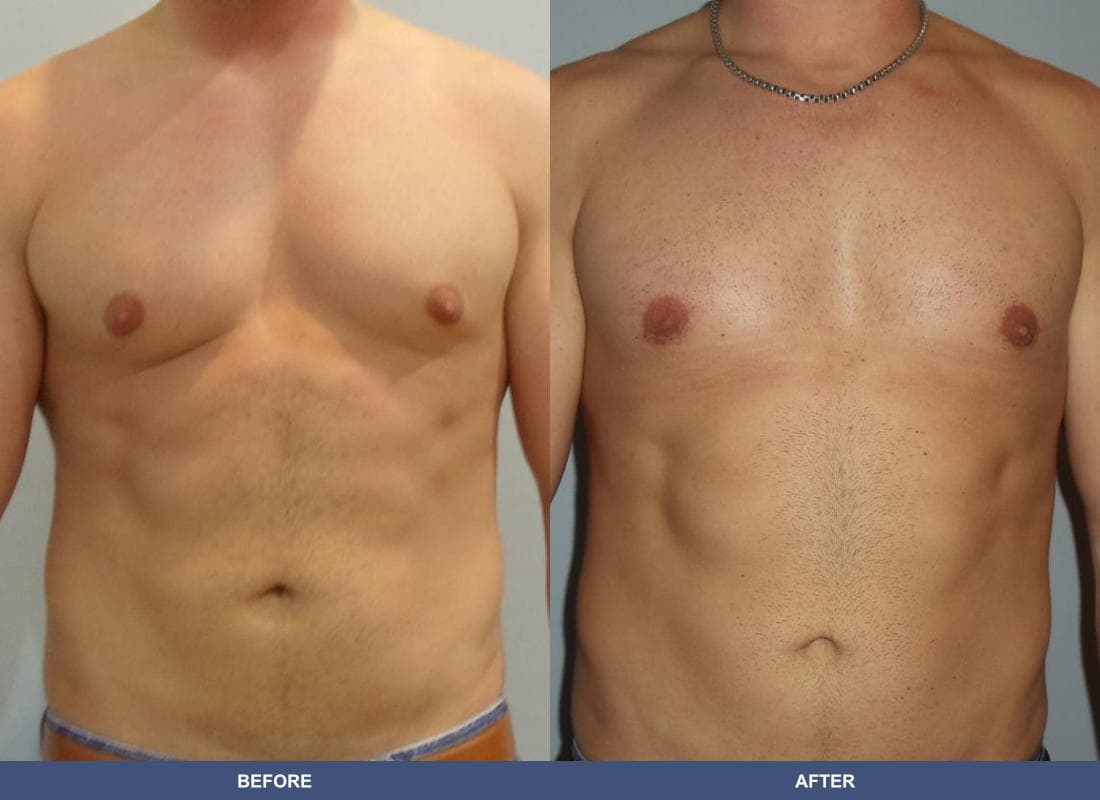 Gynecomastia before and after
