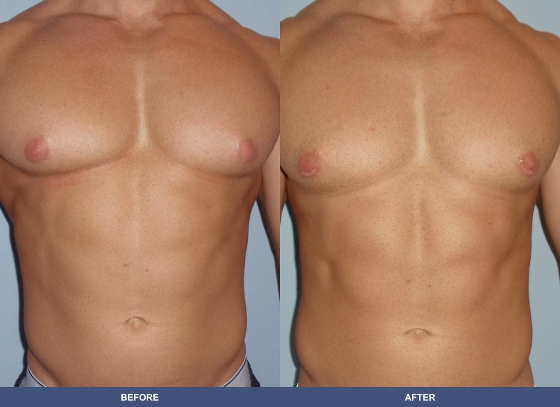 Gynecomastia before and after
