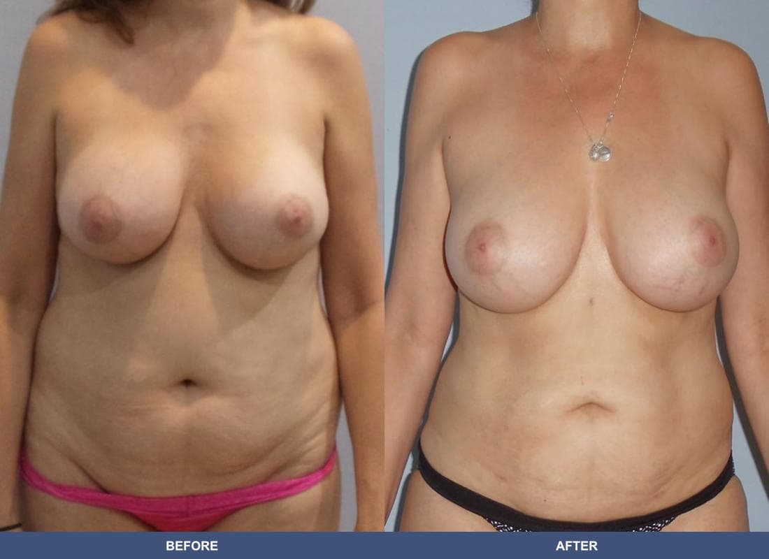Liposuction before and after