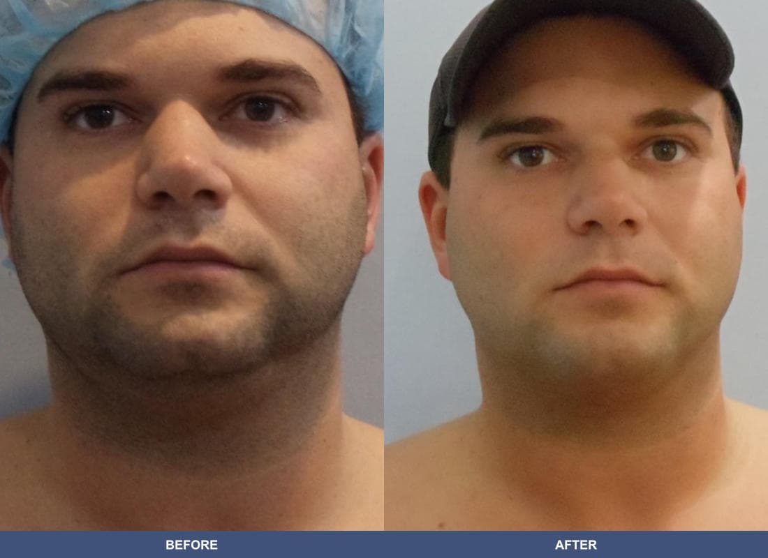 Liposuction before and after