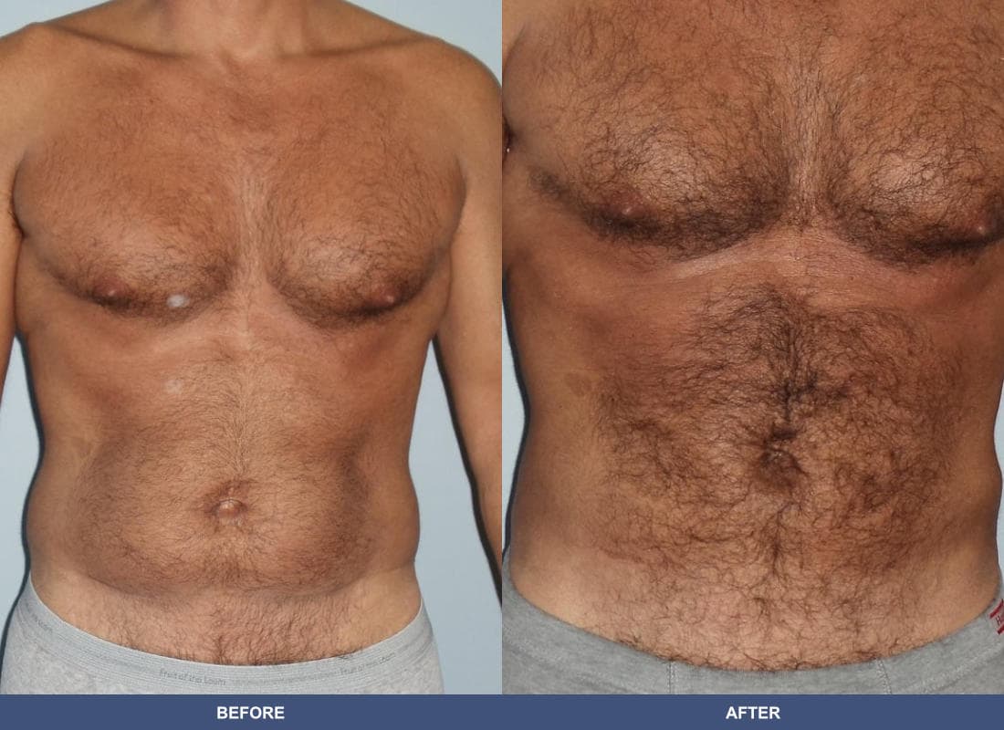 Liposuction before and after