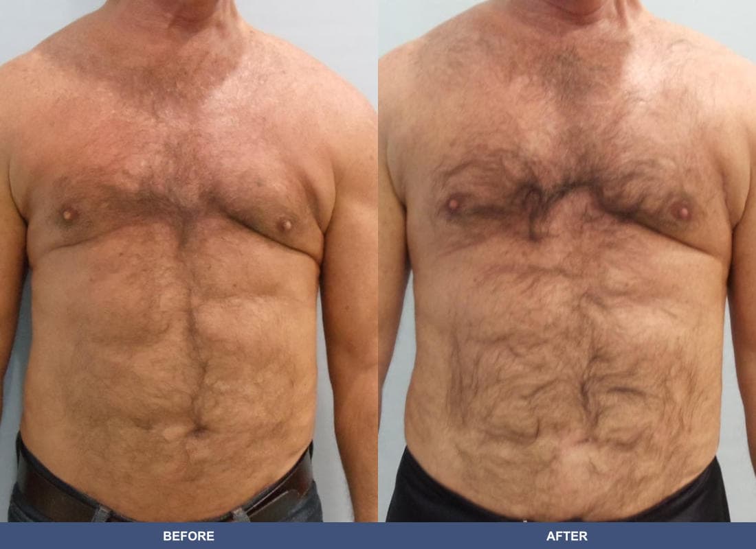 Pectoral Augmentation before and after