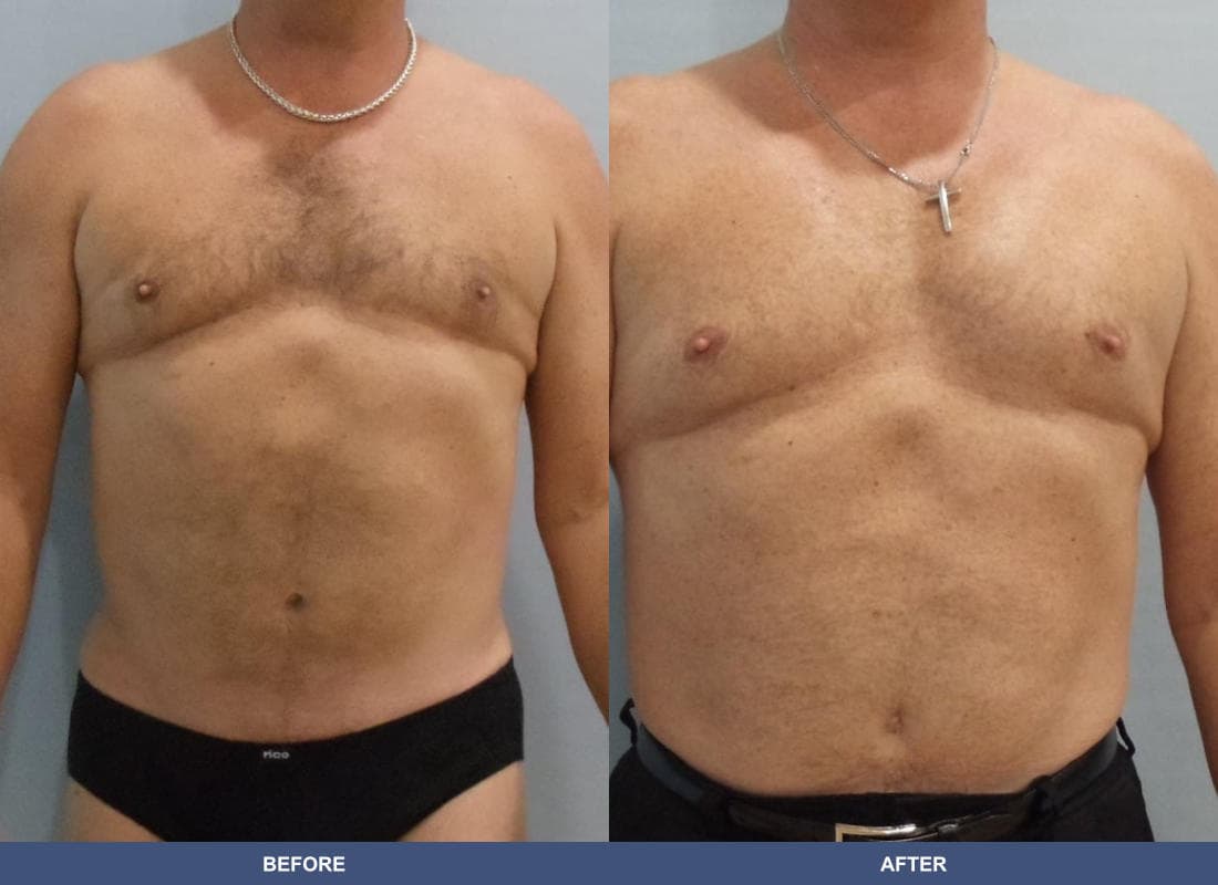 Pectoral Augmentation before and after