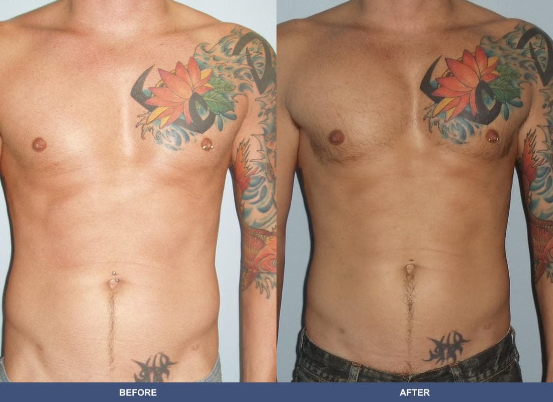 Pectoral Augmentation before and after