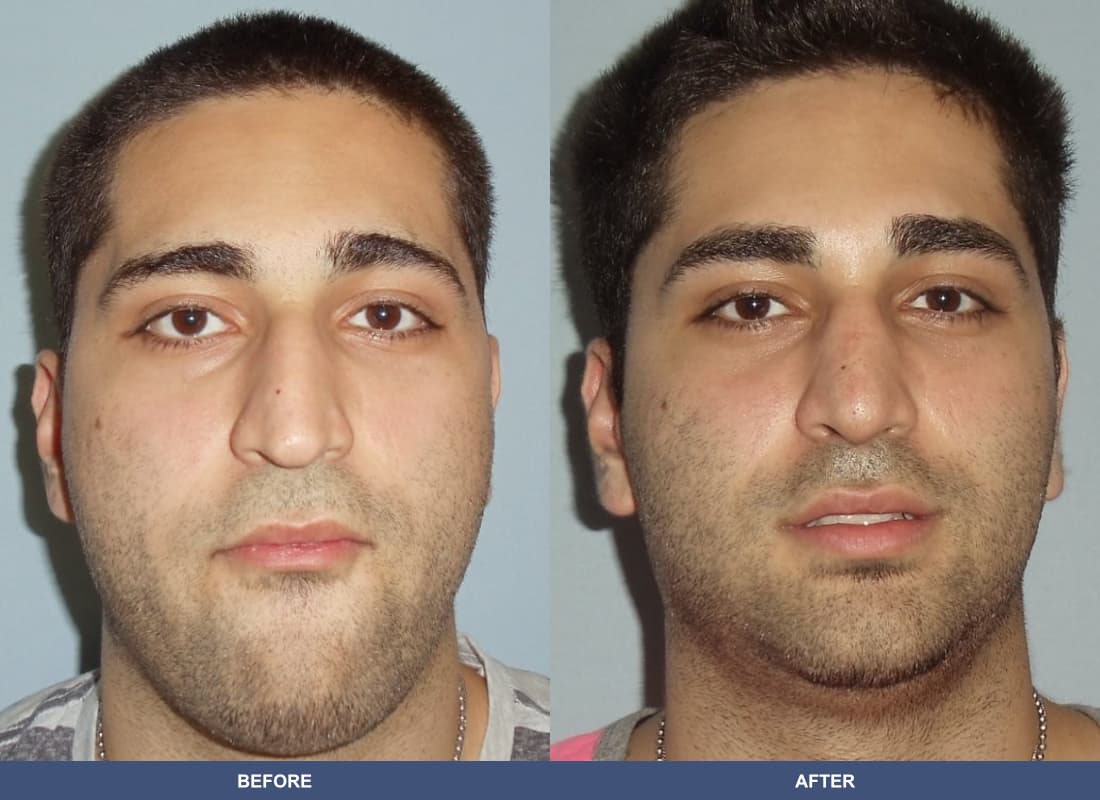 Rhinoplasty before and after