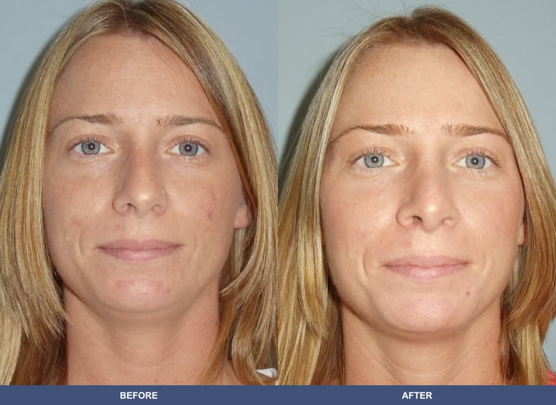 Rhinoplasty before and after