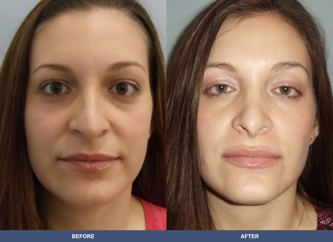 Rhinoplasty before and after