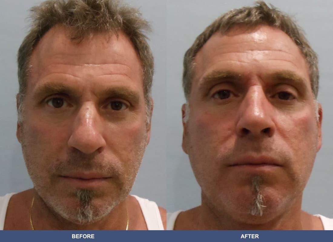 Rhinoplasty before and after