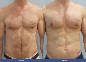 Andrick Pectoralimp Front