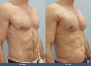 Andrick Pectoralimp Oblique