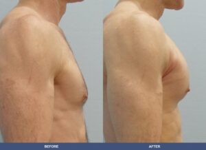 Andrick Pectoralimp Side