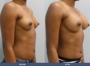 Armbrister Ba B2c Oblique