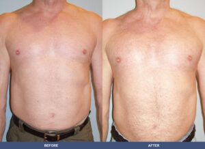 Carousella Pectoralimp Front