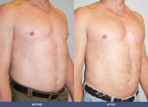 Carousella Pectoralimp Oblique