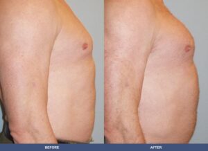 Carousella Pectoralimp Side