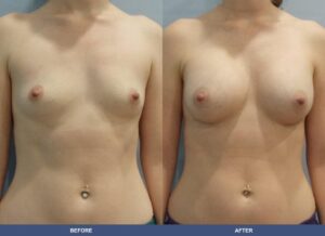 Chabaud Ba A2b Front