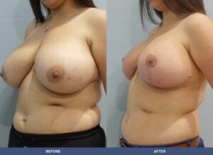 Correa Br Left Oblique