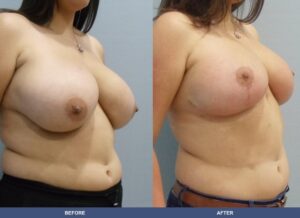 Correa Br Right Oblique