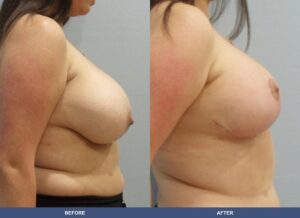 Correa Br Right Side