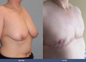 Dickson Ftm Oblique