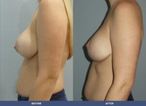 Dreyfus Bal Pexy Side