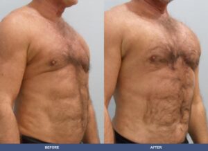 Gillingham Pectoralimp Oblique