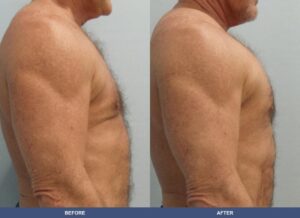 Gillingham Pectoralimp Side