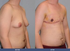 Graziani Ftm Oblique