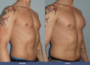 Gregory Pectoralimp Oblique